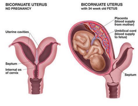 Bicornuate Uterus - Pregnancy, Symptoms, Causes, Surgery : Health Blog