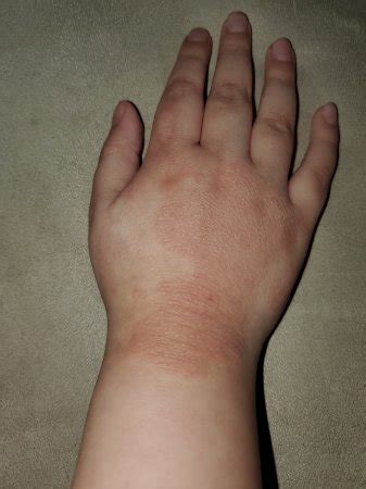 Eczema or Hives? Cat allergies? | BabyCenter