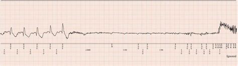 Ambulatory ECG Monitoring | Thoracic Key