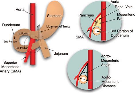 SMA syndrome causes, symptoms, diagnosis, treatment & prognosis