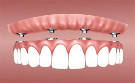 Snap-In Dentures | Implants | Types | Memphis | Hernando