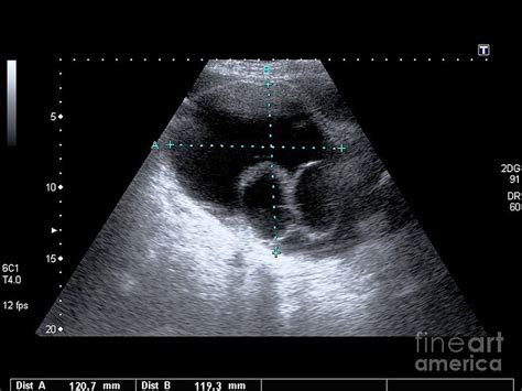 Ovarian Cyst On Ct Scan