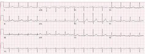 Dr. Smith's ECG Blog: "Pericarditis" strikes again