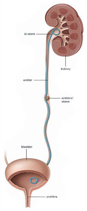 Kidney Stent - Assoc. Prof. Dr. Arif Demirbaş