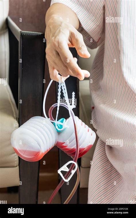 Patient holding surgical blood drainage collection device filled with blood from wound after ...