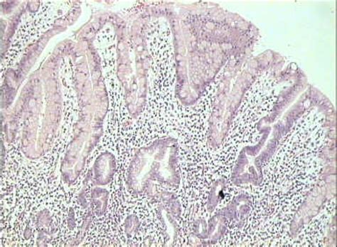 Foveolar hyperplasia Symptoms, Causes, Treatment: