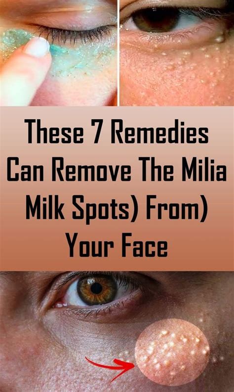 THESE 7 REMEDIES CAN REMOVE THE MILIA (MILK SPOTS) FROM YOUR FACE – luxurysarah | Healthy skin ...