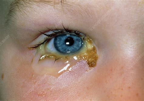 Acute conjunctivitis & discharge from child's eye - Stock Image - M155 ...