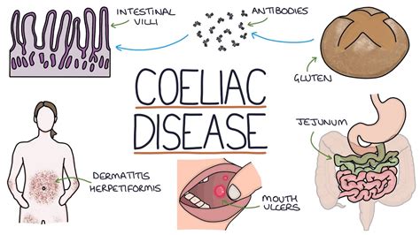 Celiac Disease: Causes, Symptoms, and Diet | September 2023