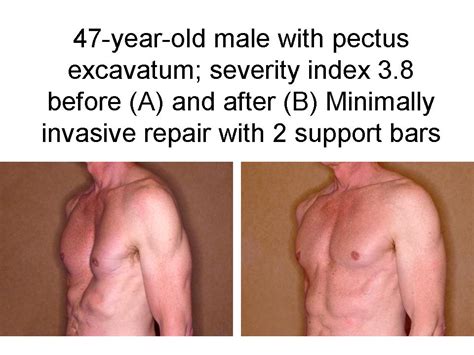 WTSA - Minimally Invasive Repair of Pectus Excavatum in Adult Patients: An Early Experience ...