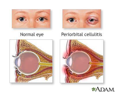 Eye Orbital Cellulitis