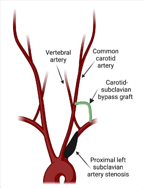 Graphic illustrates a carotid-subclavian bypass graft. Created with... | Download Scientific Diagram