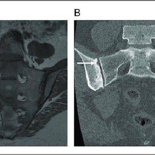 35-year-old female with dedicated Sacroiliac joint MRI and CT. (A) MRI ...