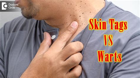 What Causes Skin Tags And Warts? | Get Rid of Warts & Skin Tags- Dr. Renuka Shetty | Doctors ...