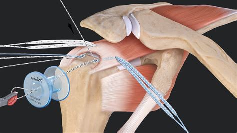 Arthrex - FiberTak® SpeedBridge™ Rotator Cuff Repair