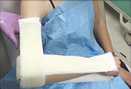 Splints and Casts: Indications and Methods | AAFP