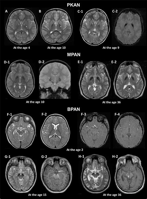 Abnormal Brain MRI Results