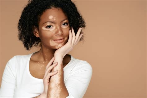 Vitiligo: Symptoms, Causes and Treatments - Parade