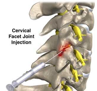 Cervicalgia or Neck Pain: What are the Causes and Treatment Options