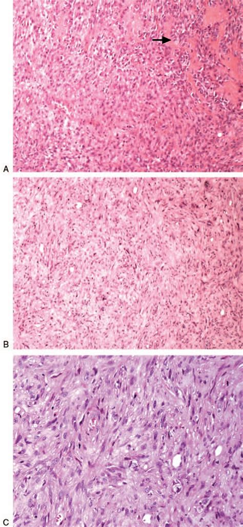 Angiosarcoma - Causes, Symptoms, Life Expectancy, Treatment