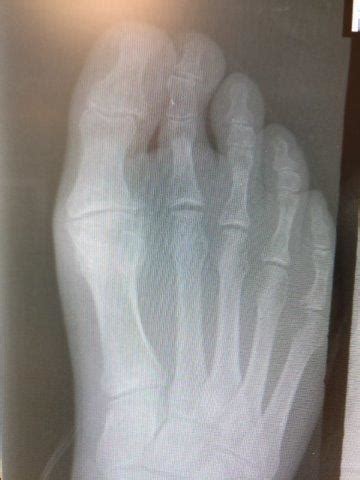 Big Toe Joint Pain Replacement Surgery [Best Recovery Time]