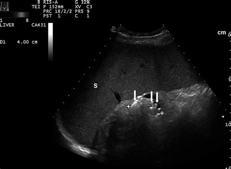 Contrast Enhanced Ultrasonography for the Evaluation of Coil Embolization of Splenic Artery ...