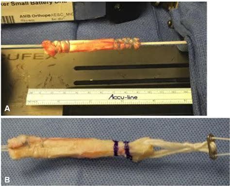 Quadriceps tendon autograft for arthroscopic knee ligament reconstruction: use it now, use it ...