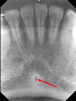 Dental Landmarks Flashcards | Quizlet