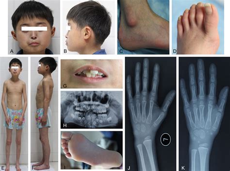 Figure 1 from stature as the first manifestation of mandibular hypoplasia , deafness , progeroid ...