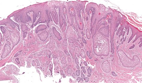 Peripheral Ameloblastoma Histology