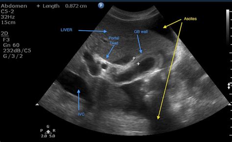 Gallbladder wall thickening= cholecystitis? ~ Ultrasound Cases Info