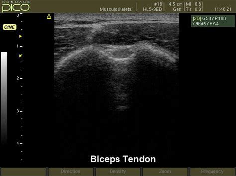 Ultrasound images • Biceps tendon, B-mode, echogramm №276