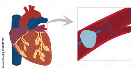 Cardiac cryoablation illustration. Inside pulmonar vein and catheter ...