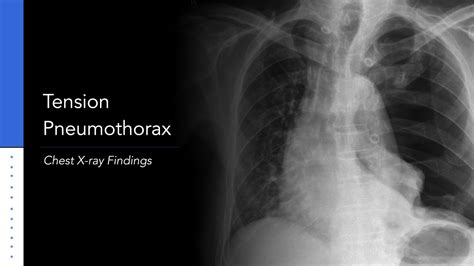 Tension Pneumothorax: Explanation of Chest X-ray Findings - YouTube