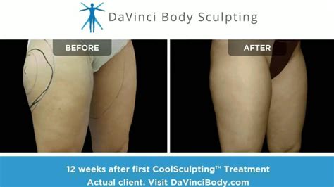 Can CoolSculpting Slim Your Thighs? Real Before & After Results - YouTube