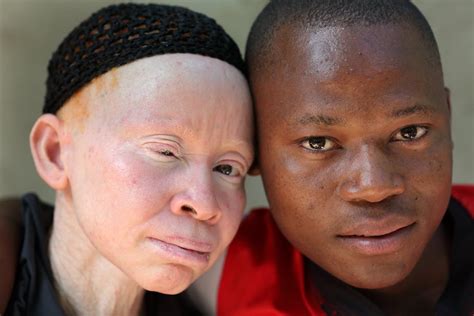 Being black in a white skin: students with albinism battle prejudice