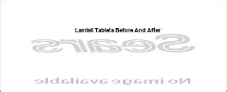 Lamisil tablets before and after, lamisil tablets before and after - Fast and secure ...