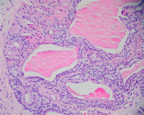 Ectopic parathyroid gland in pyriform sinus (?) 3 | H&E, 200… | Ed Uthman | Flickr