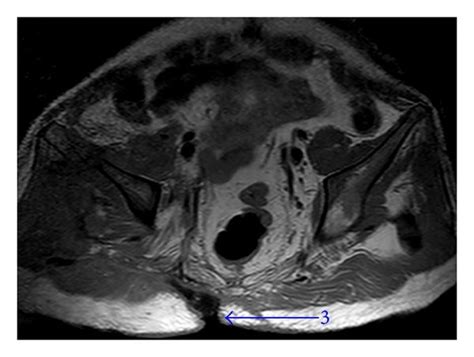 (a) X-ray image of the pelvic fracture four months after trauma (1 ...