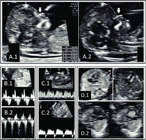 Down Syndrome Ultrasound Markers