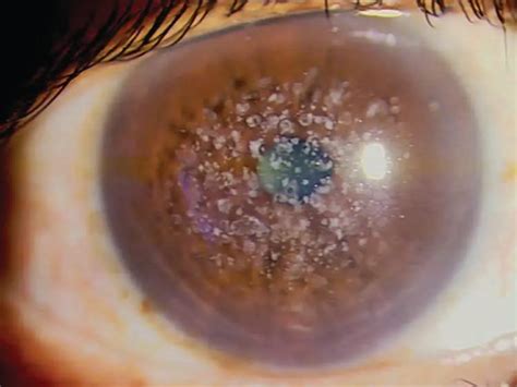 Granular corneal dystrophy - American Academy of Ophthalmology