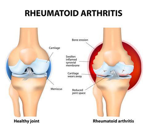 Juvenile idiopathic arthritis: MedlinePlus Genetics