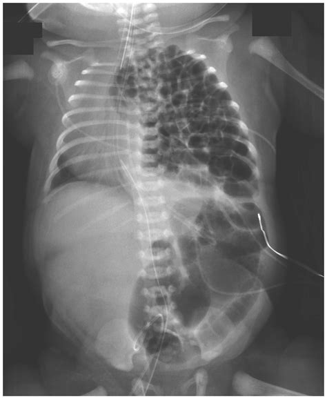 Congenital Diaphragmatic Hernia | NEJM