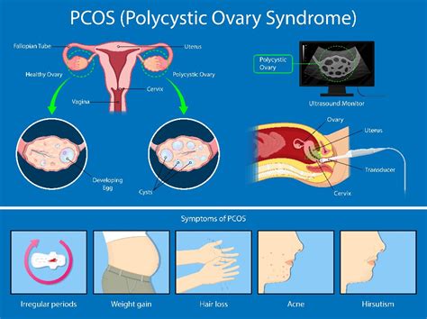 Female Non Surgical PCOS Treatment, Mathrutva A Unit Of Max Fertility ...