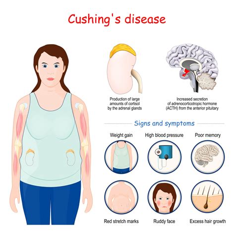 Quels sont les causes et traitements du syndrome de Cushing ? - esculape