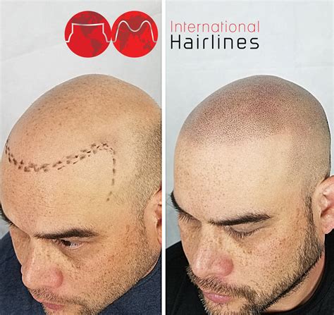 Scalp Micropigmentation Aftercare | International Hairlines