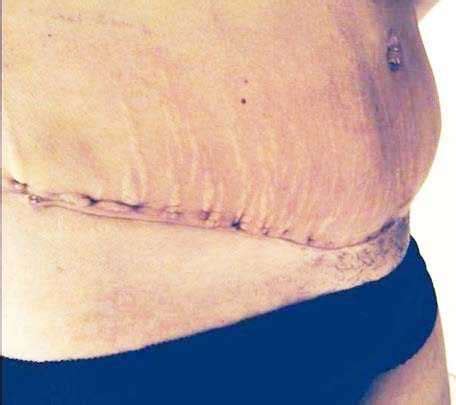 Images of abdominoplasty scars (4) » Tummy Tuck: Prices, Photos ...