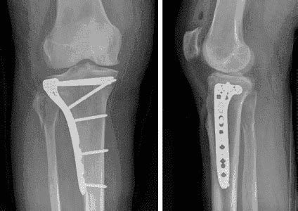 Tibial Plateau Fractures: Basic Anatomy, Mechanism, Treatment, and Complications