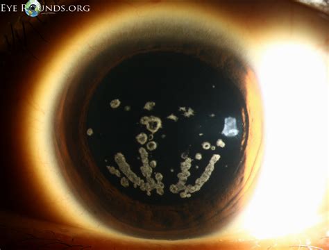 Granular corneal dystrophy