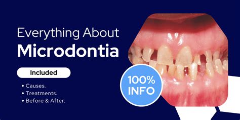 Microdontia - Basics, Causes, Treatments, Before & After